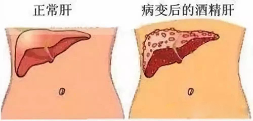 长期饮酒,不止是伤肝